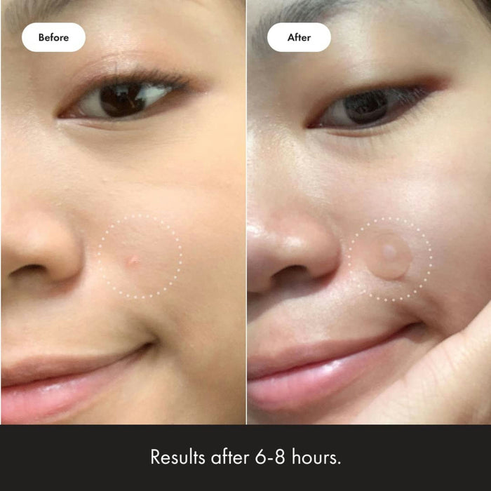 Mighty Patch Acne Treatment