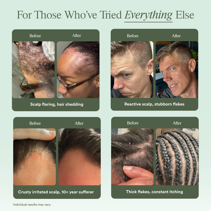 Scalp Relief System